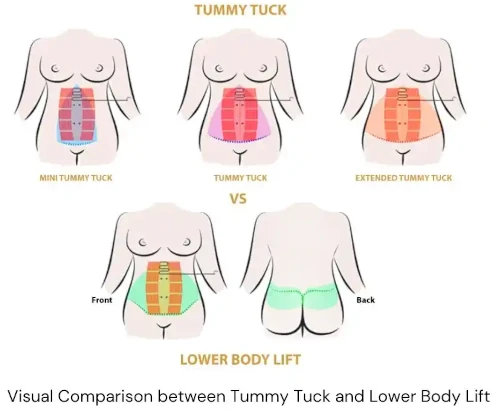 Visual Comparison between Tummy Tuck and Lower Body Lift